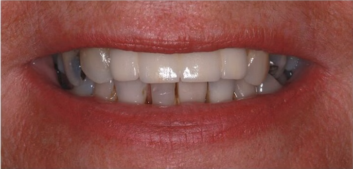 Before treatment
